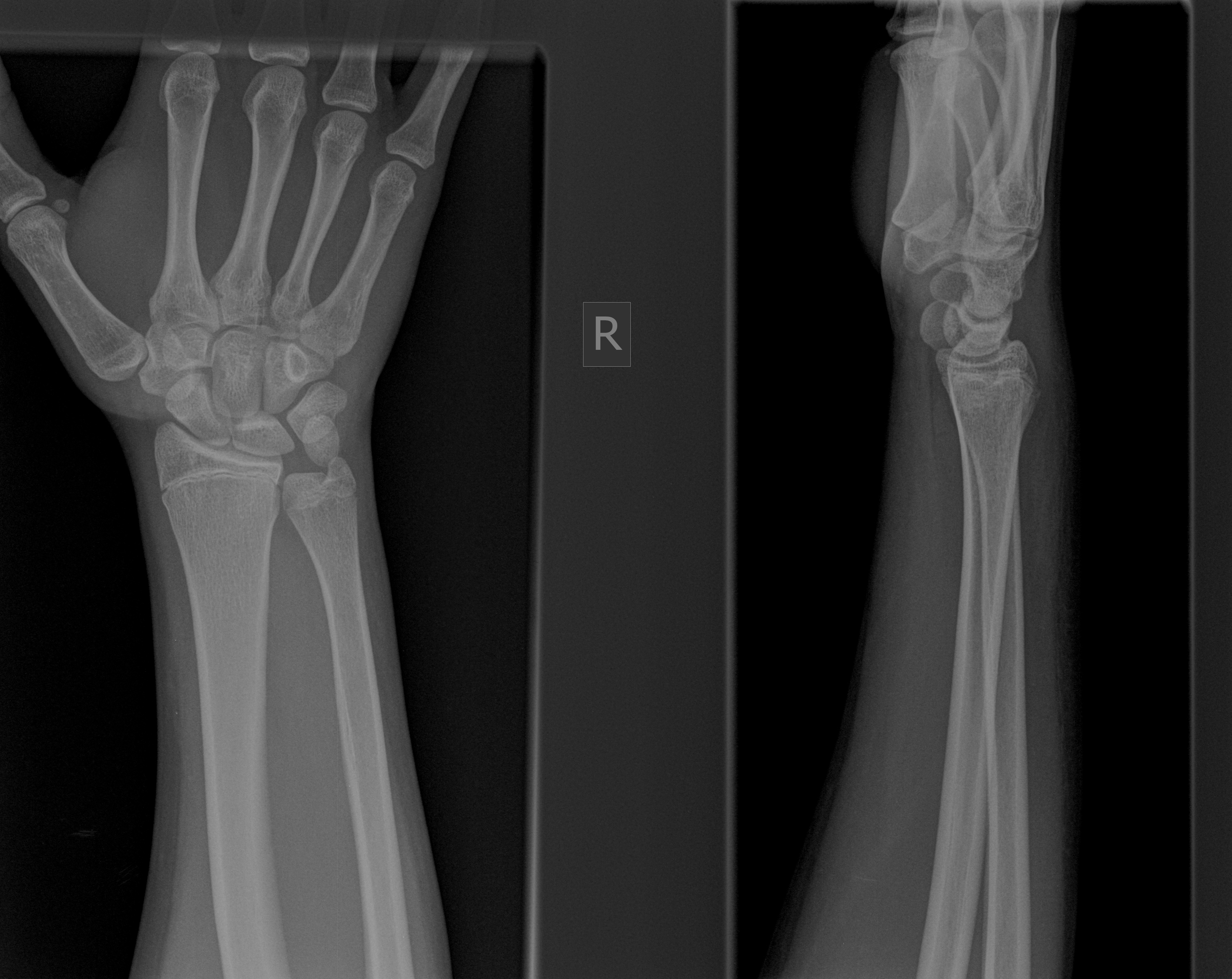 Right Wrist Pain Icd 10 Code - 5gob4mp